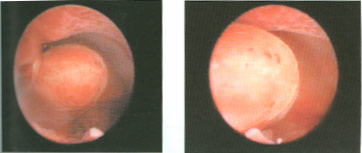 полип эндометрия при гистероскопии