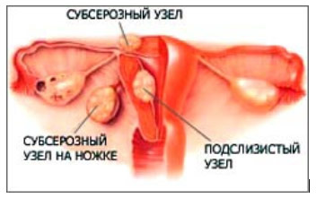 Миома (фибромиома, лейомиома, фиброма) матки, симптомы - Клиника Здоровье г. Екатеринбург
